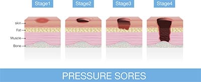 Image of pressure sores, 2 of 2