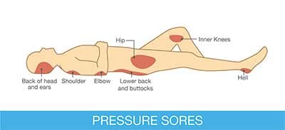 Image of pressure sores, 1 of 2